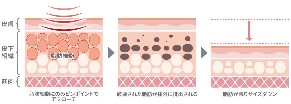 ヴァンキッシュMEの高周波エネルギー照射