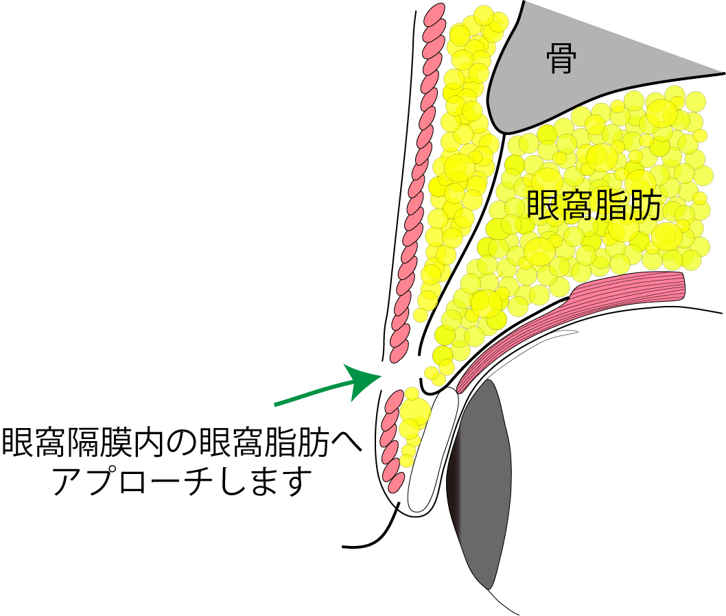 目の上の脂肪取り ポイント
