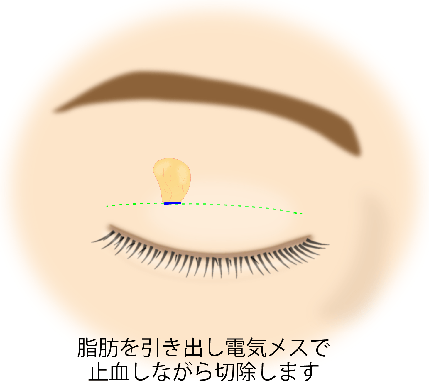 目の上の脂肪取り ポイント