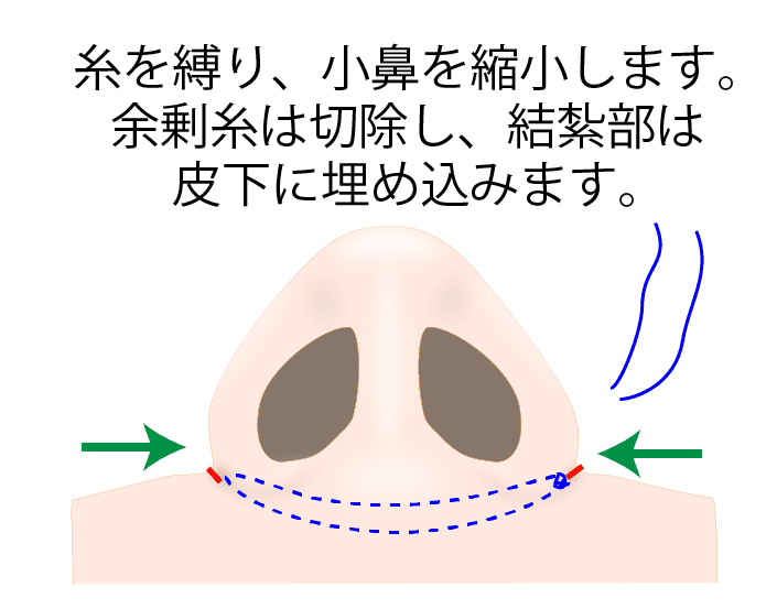 ③糸を縛り小鼻を縮小