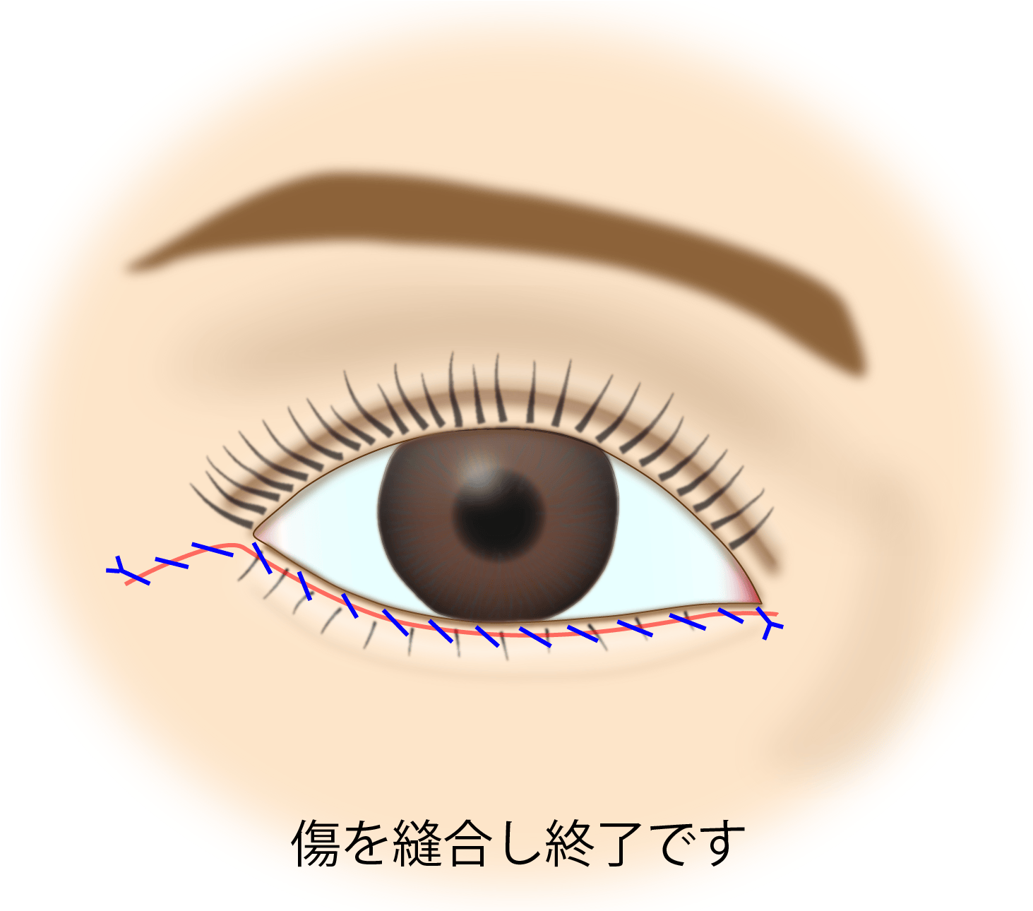 目の下のたるみ取り施術の流れ