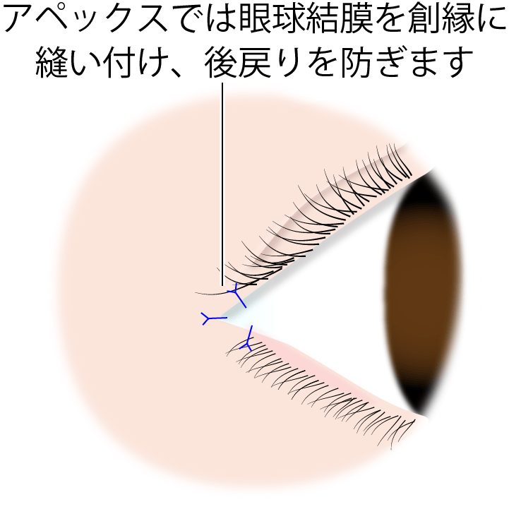 アペックス