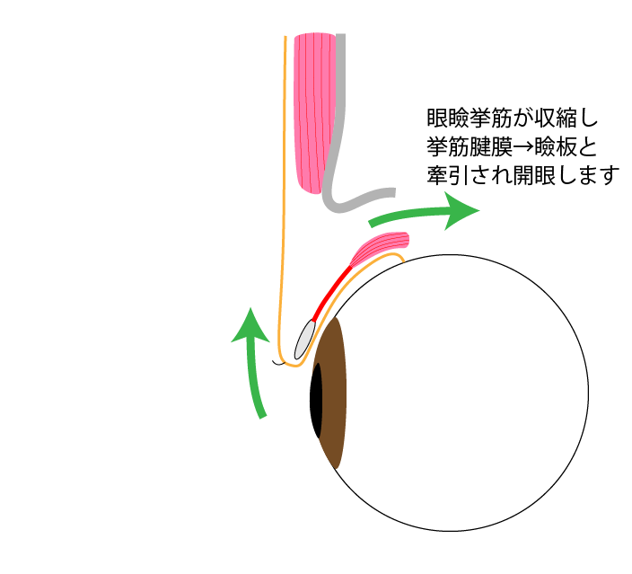 黒目見開きアップ術施術の流れ