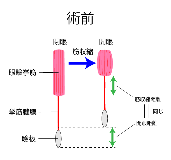 黒目見開きアップ術施術の流れ
