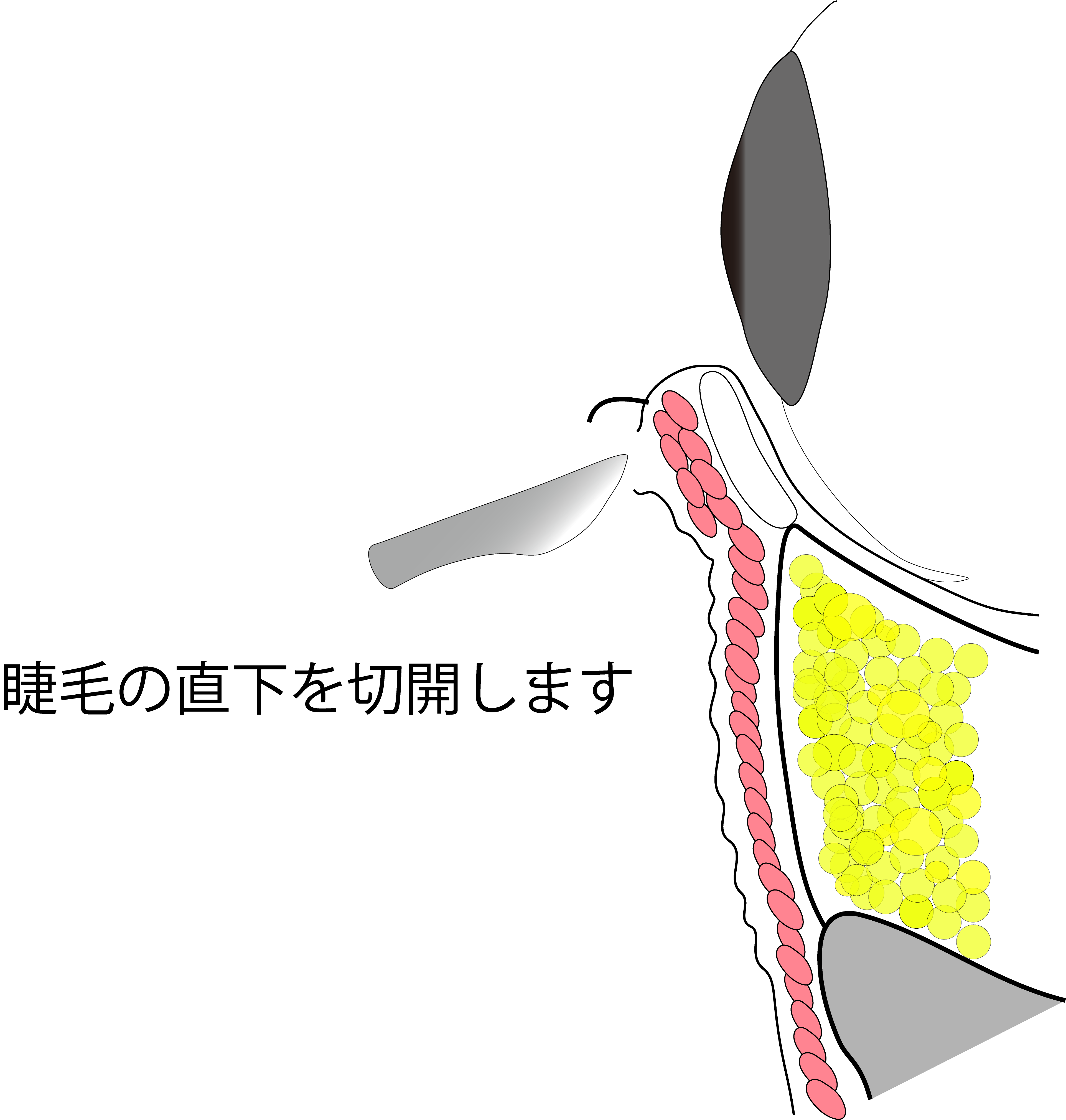 目の下のたるみ取り施術の流れ