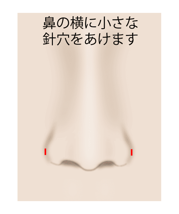 ①鼻横に小さな針穴をあける