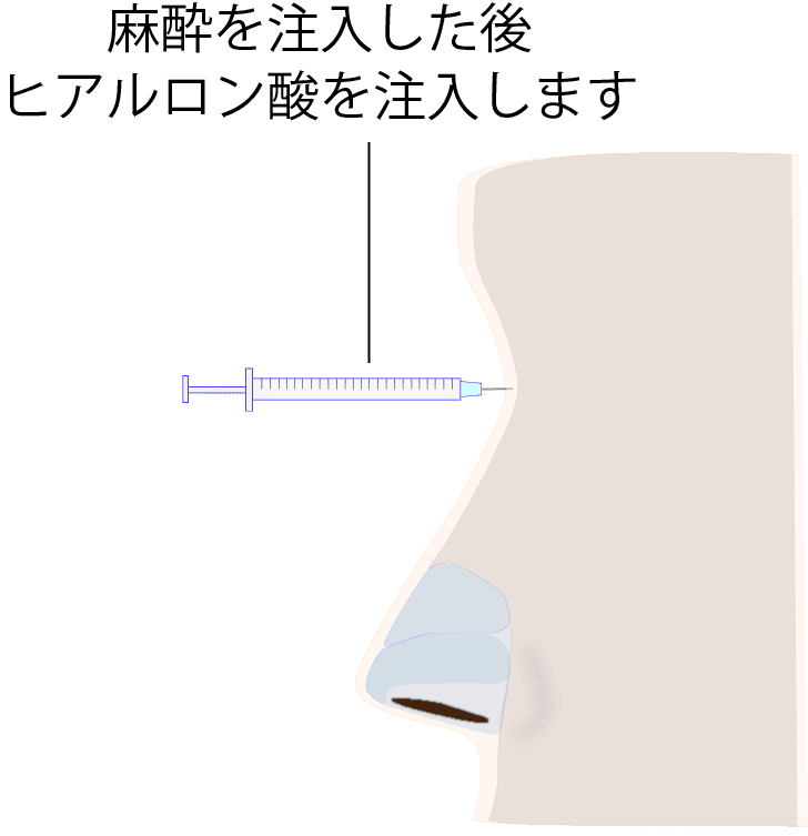 ヒアルロン酸を注入