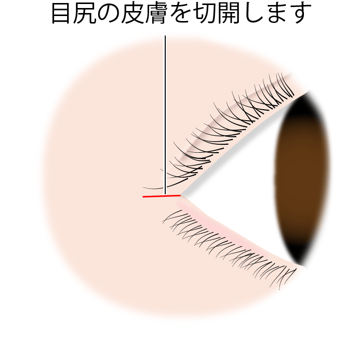 目尻の皮膚を切開