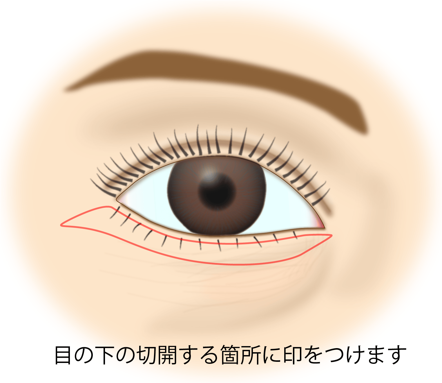 目の下のたるみ取り施術の流れ
