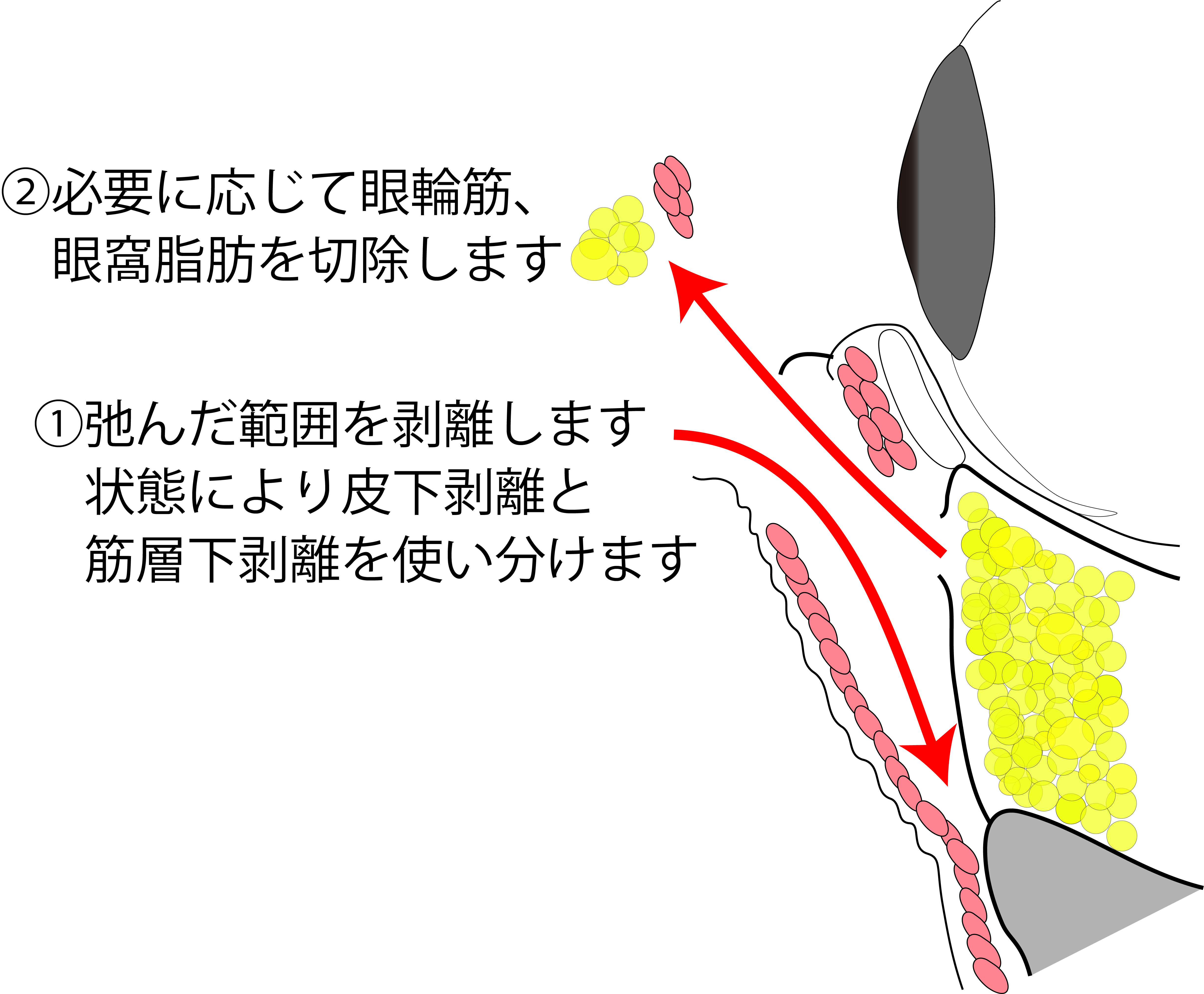 目の下のたるみ取り施術の流れ