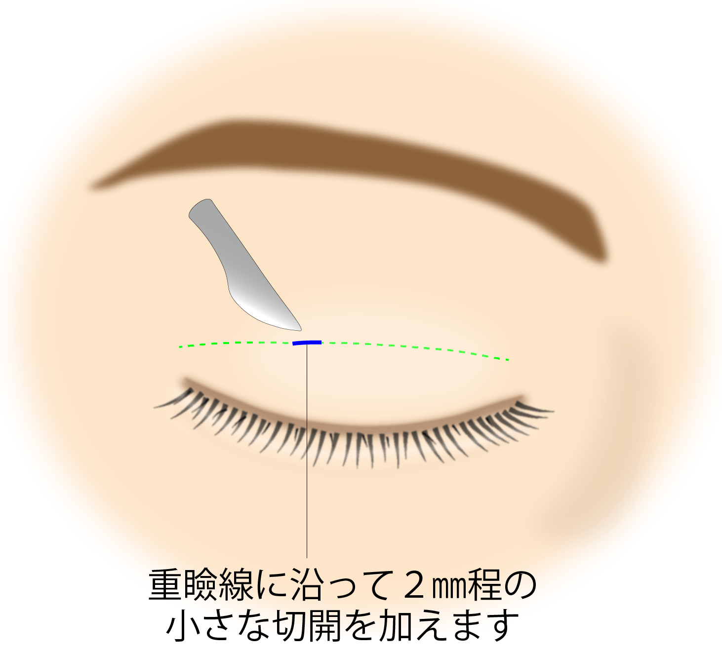 目の上の脂肪取り ポイント
