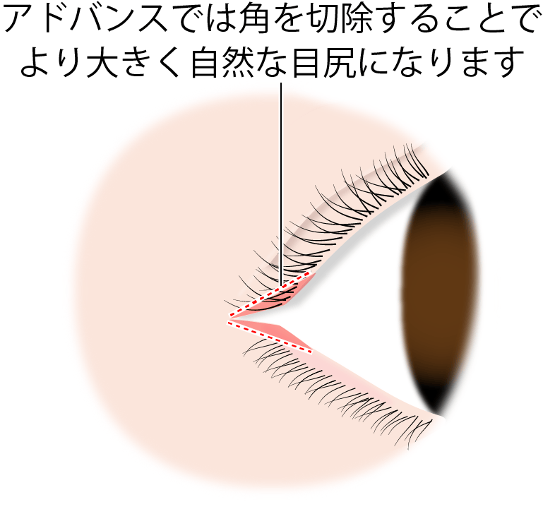 アドバンス