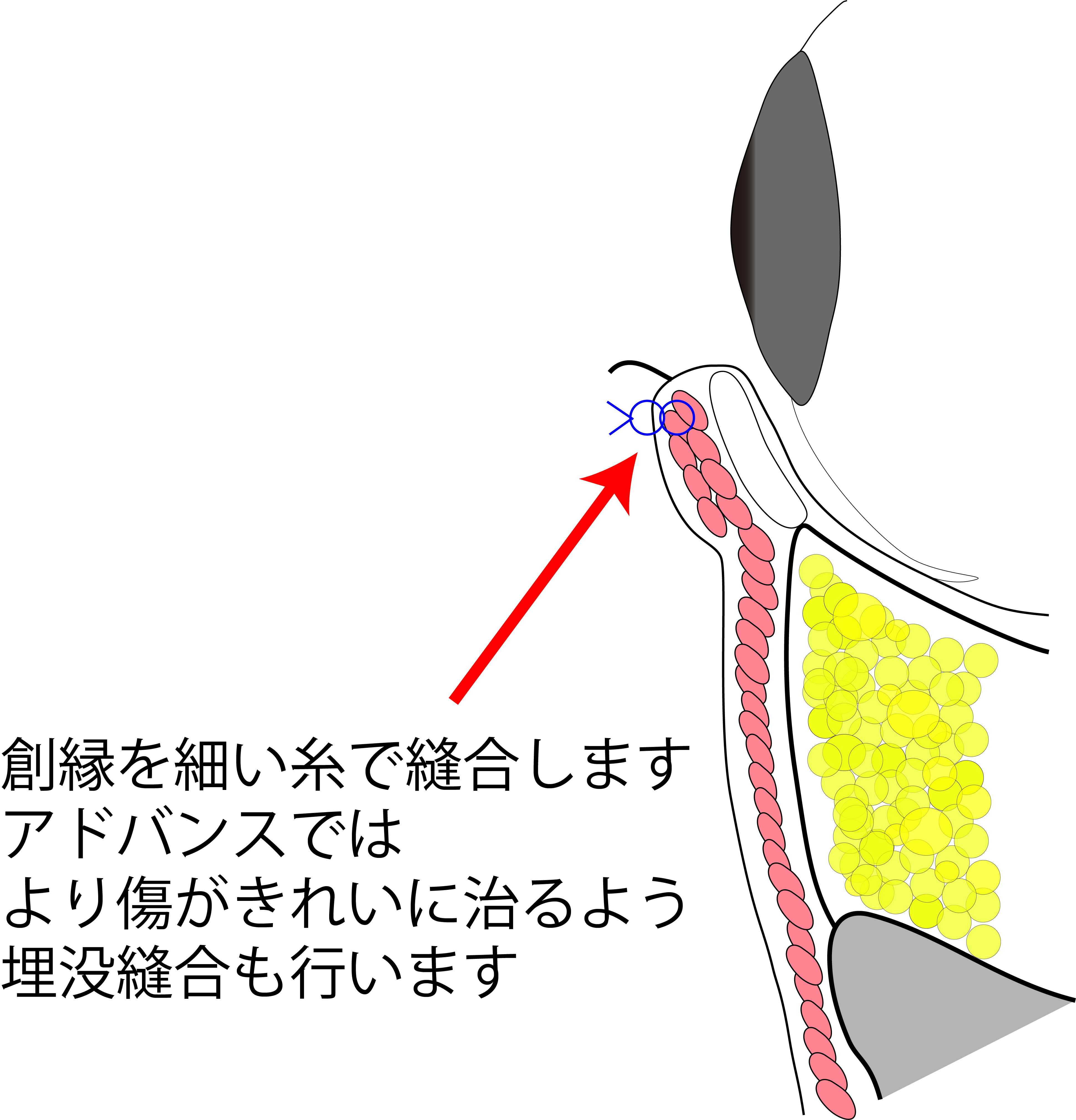 目の下のたるみ取り施術の流れ