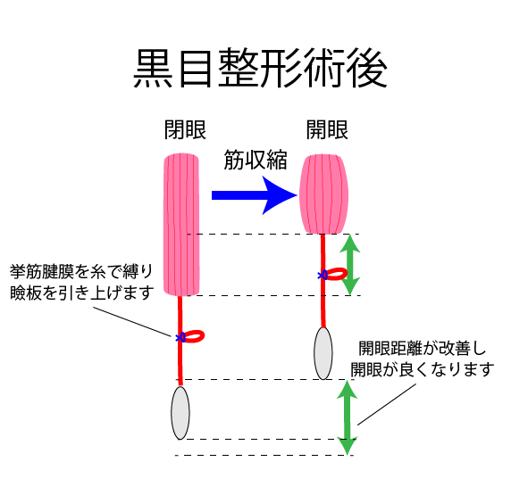 黒目見開きアップ術施術の流れ
