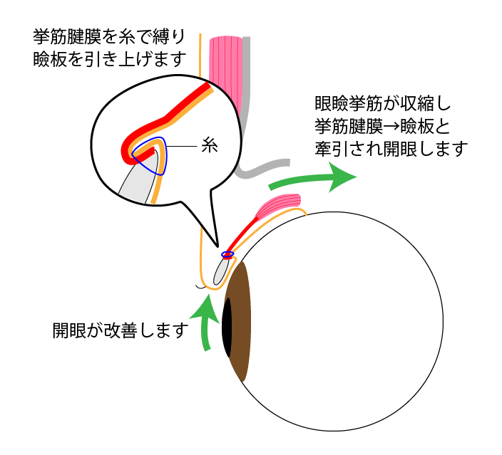 黒目見開きアップ術施術の流れ