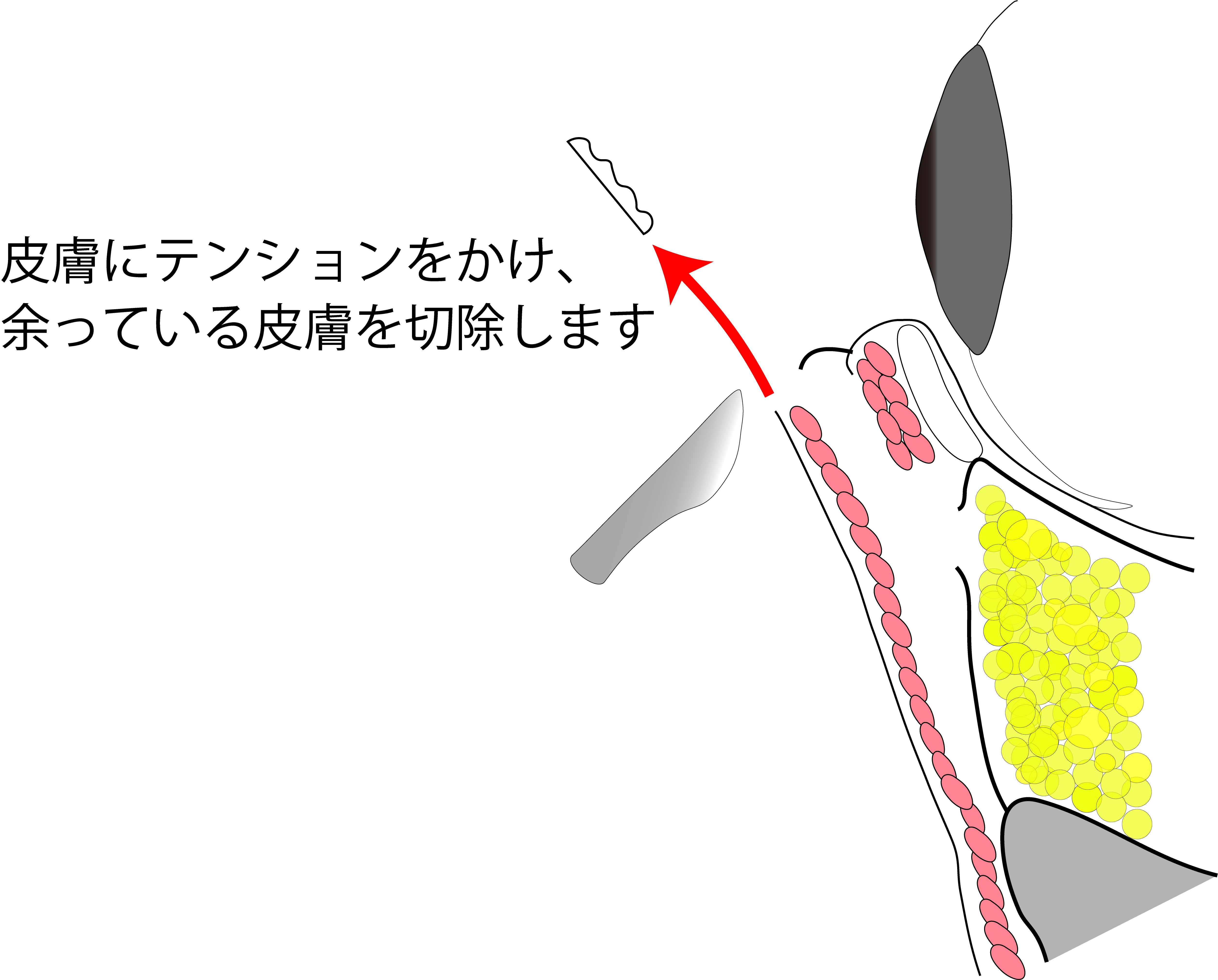 目の下のたるみ取り施術の流れ
