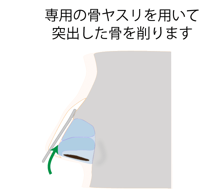 ④突出した骨を削る