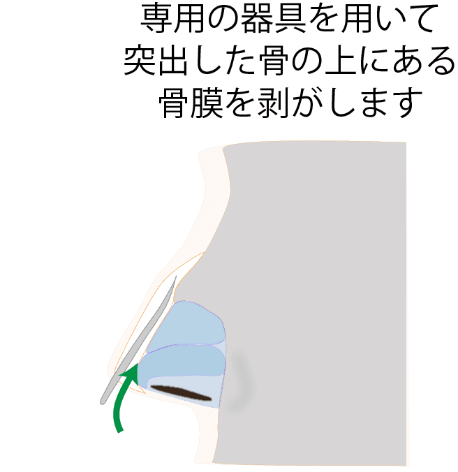 ③骨膜を剥がす