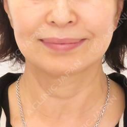 たるみ治療Aスレッド