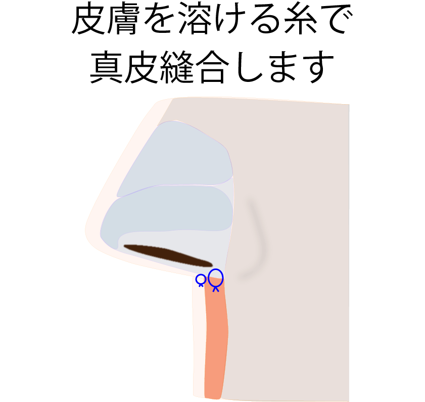 人中短縮術 施術の流れ