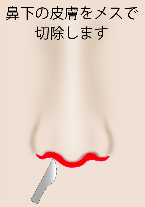人中短縮術 施術の流れ