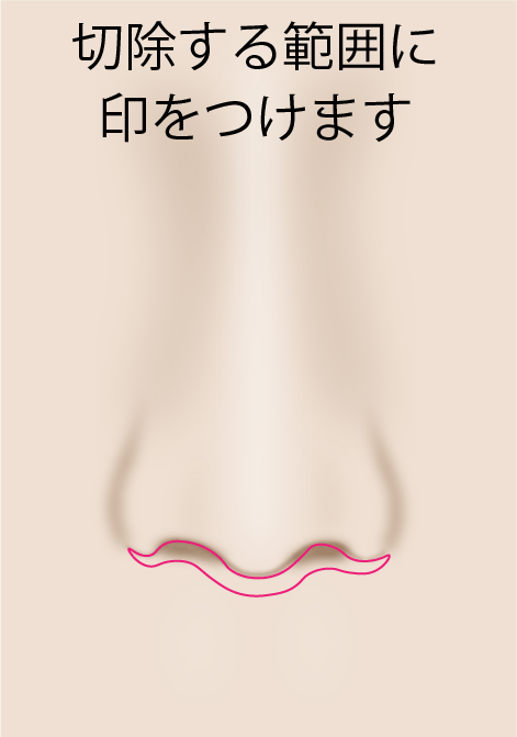 人中短縮術 施術の流れ