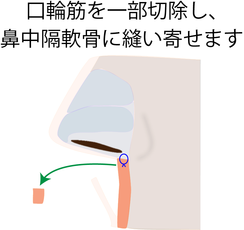 人中短縮術 施術の流れ