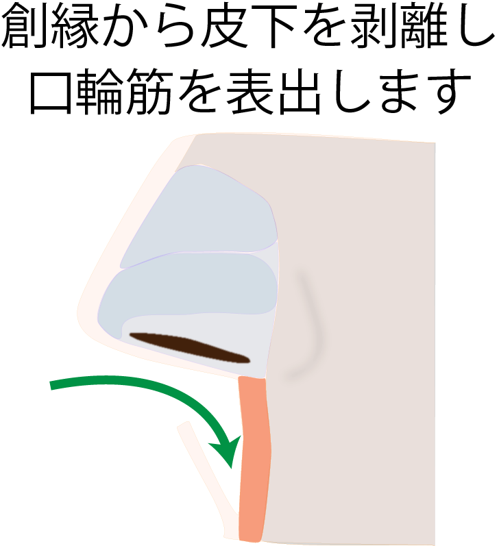 人中短縮術 施術の流れ