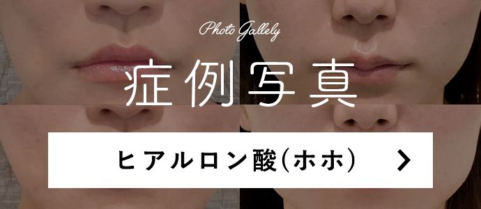 頬（ホホ）へのヒアルロン酸のポイント
