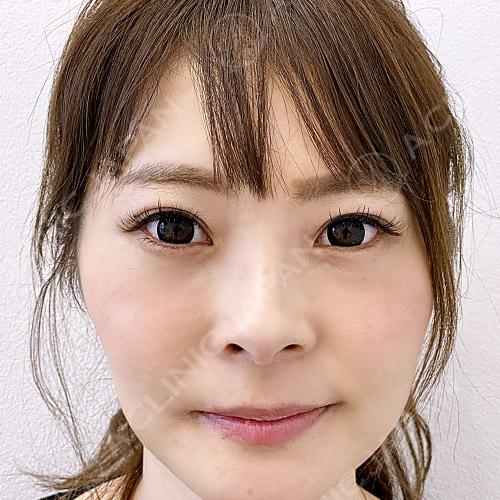 の下のたるみとり症例