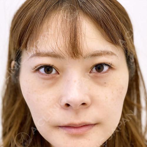 目の下のたるみとり症例