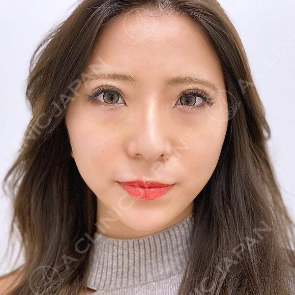 AFTER