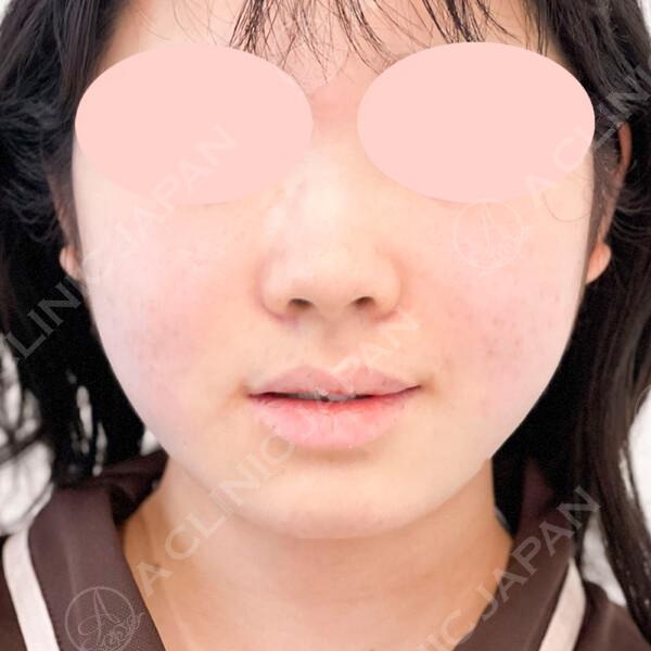 AFTER