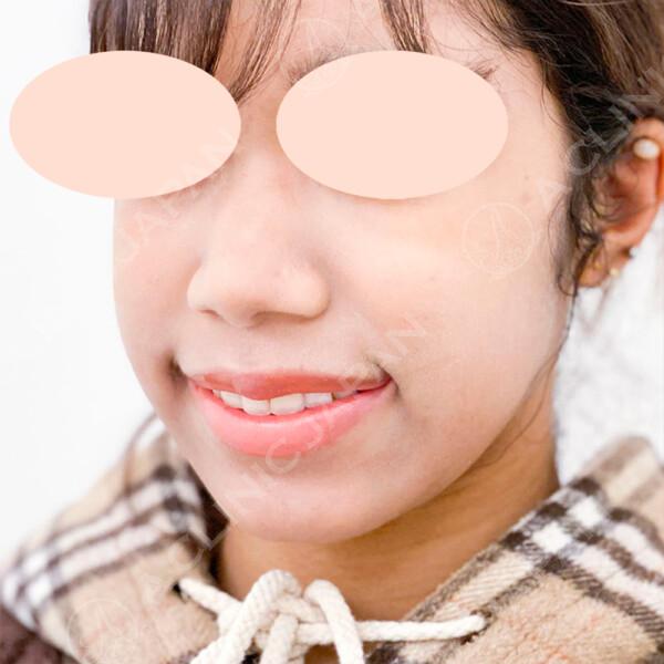 AFTER
