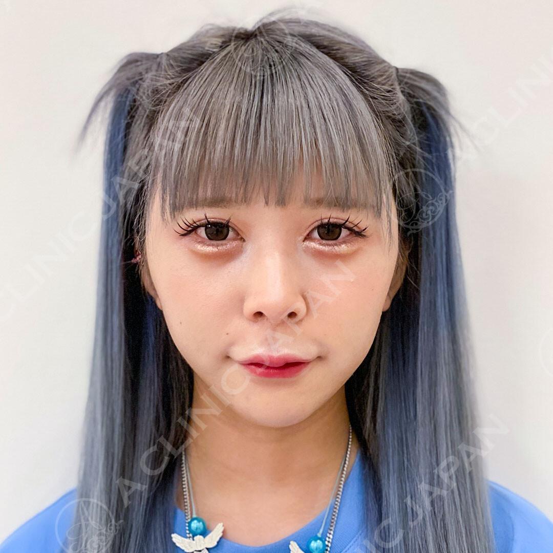 AFTER