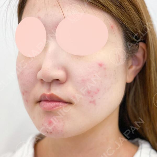 BEFORE