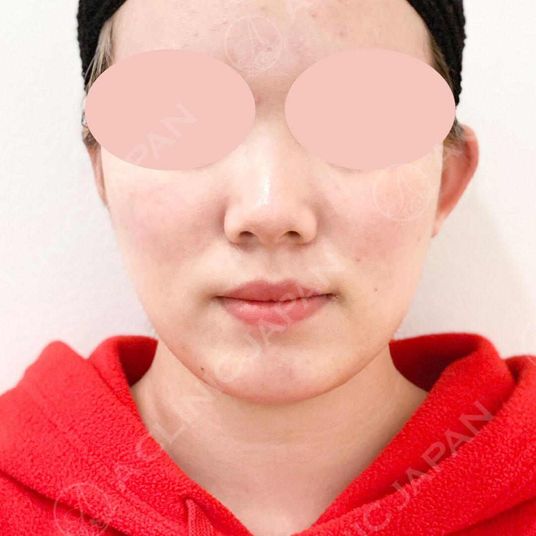 AFTER