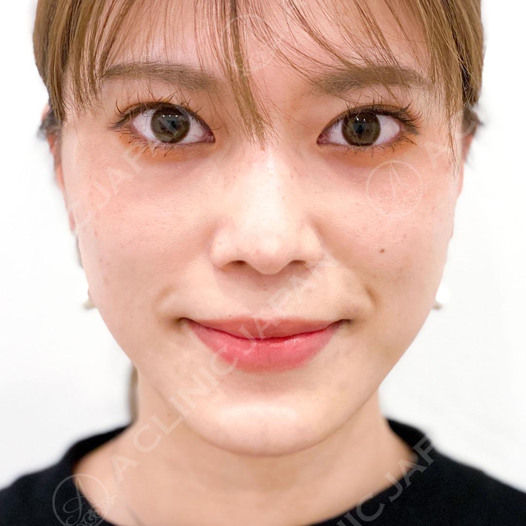 AFTER
