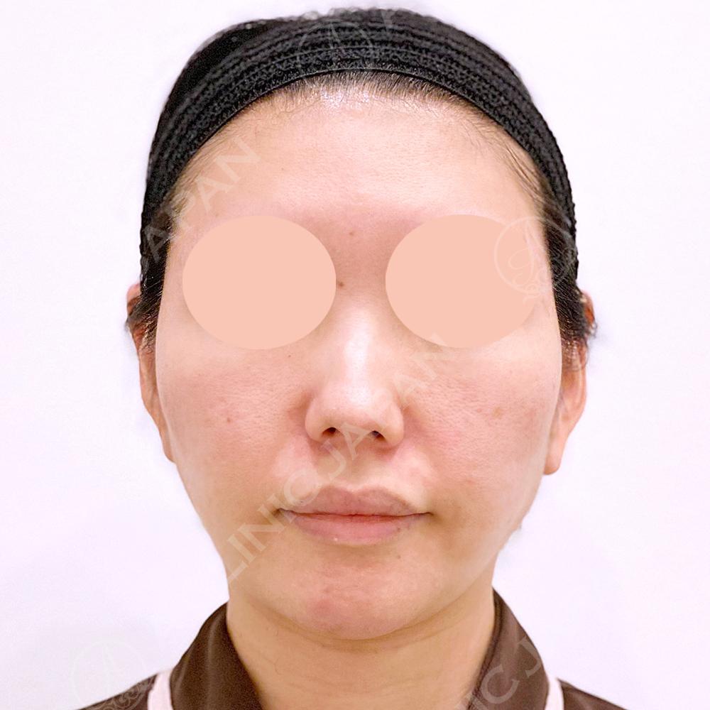 顔の横幅縮小術(脂肪吸引)before3