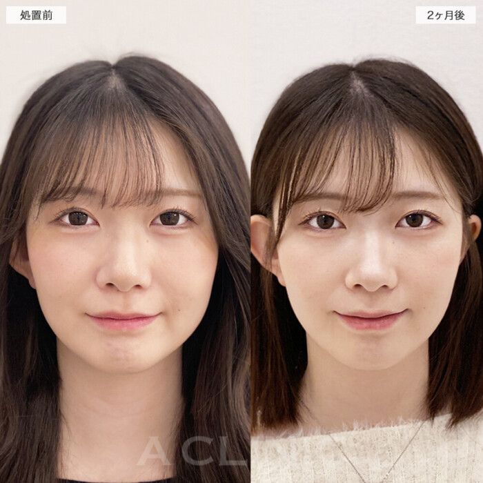 顔の脂肪吸引の症例写真