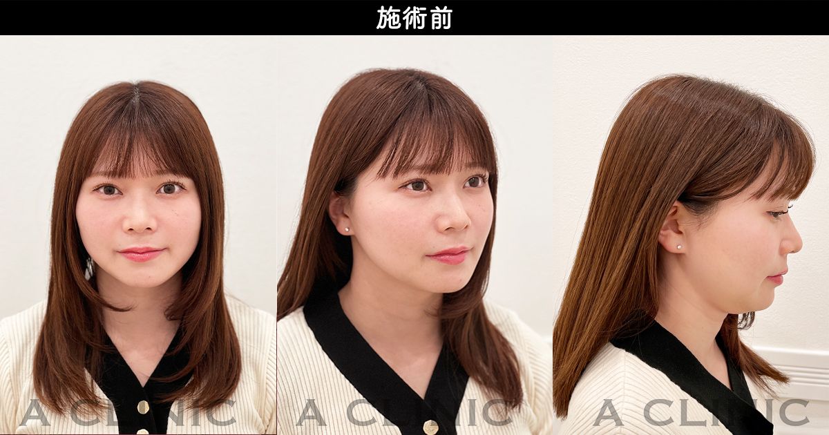顔の脂肪吸引のダウンタイムの経過を紹介します。初めは浮腫(むくみ)や腫れからはじまり、次第に内出血となり、完成形に近づいていきます。