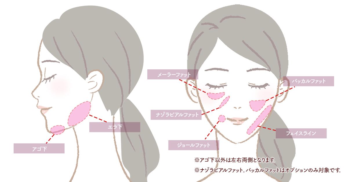 顔の脂肪吸引ができる部位の図